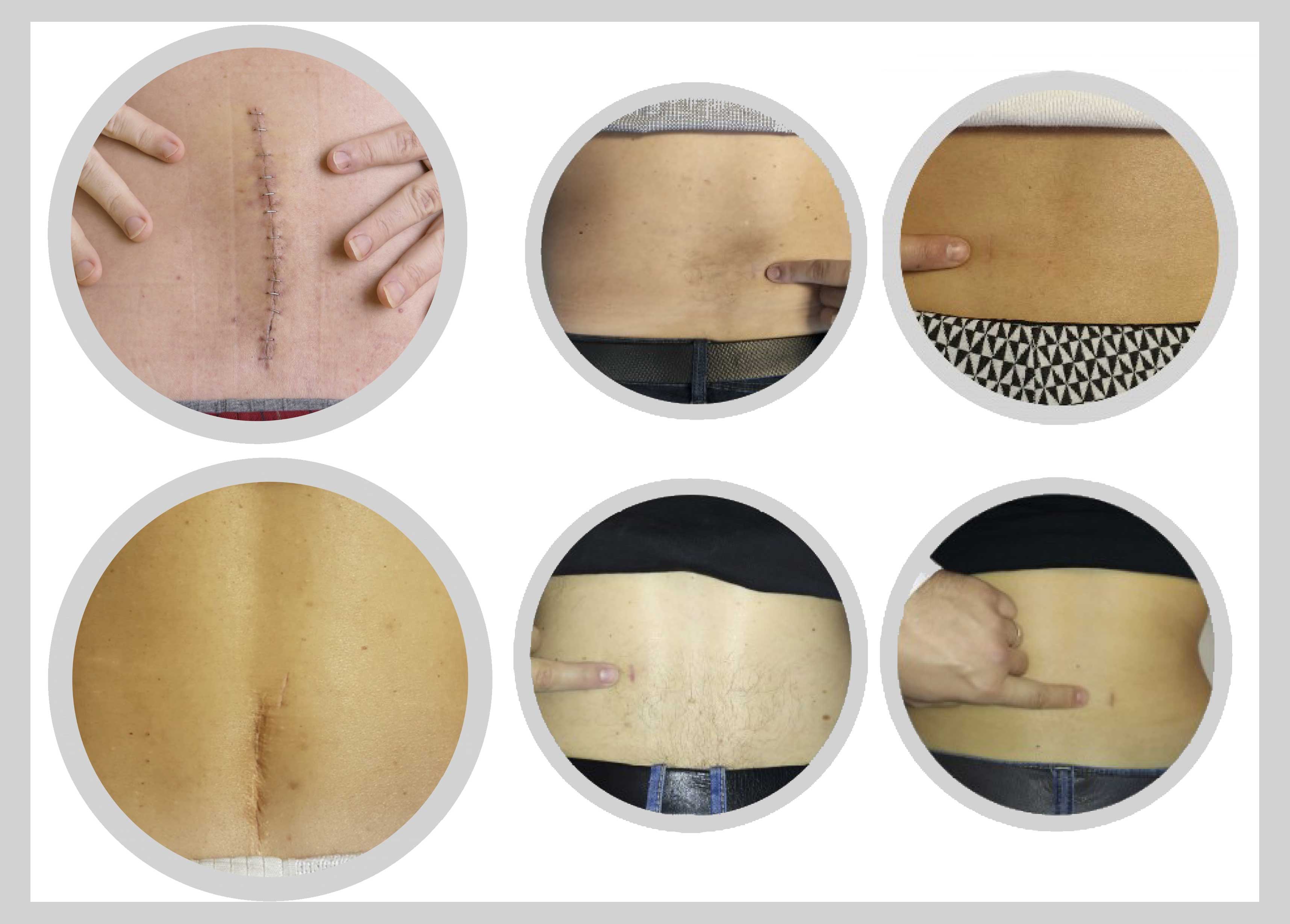 incision