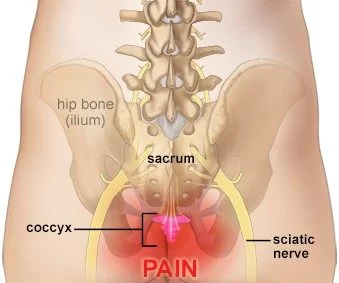 Coccis | Durerea coccisului - Dr. Mindea