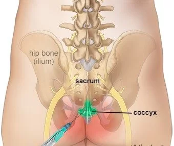 Coccidinia