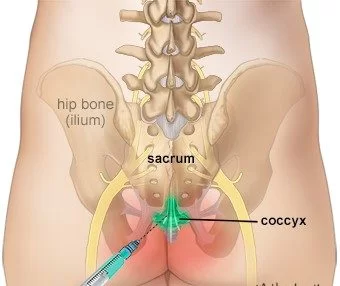 Durerea din regiunea coccisului