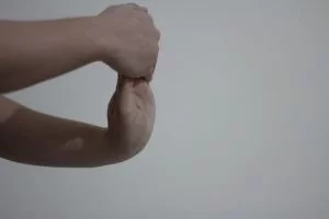 Sindromul de tunel carpian