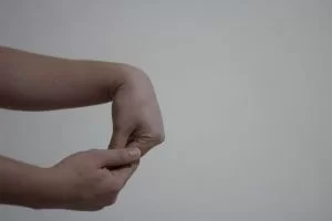Sindromul de tunel carpian