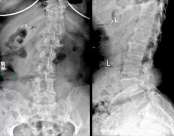 Scolioza - Deformările coloanei vertebrale