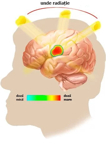 adenom-hipofizar-8
