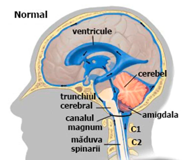 arnold chiari