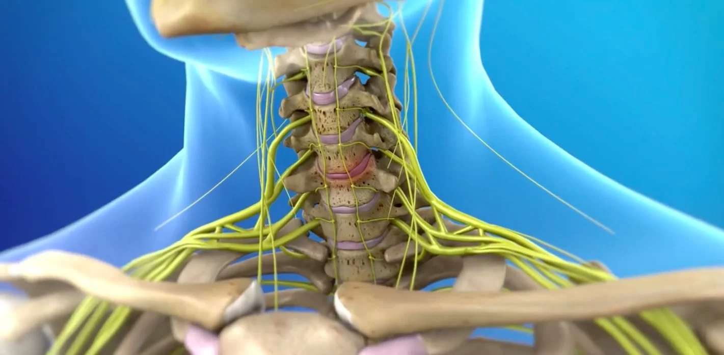 Остеохондроз шейный нерв