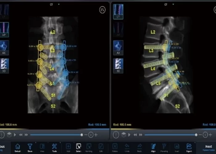 Standardul American în Neurochirurgia Minim Invazivă