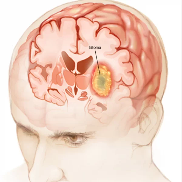 Diagnostic si tratament pentru glioblastom la clinica Mindea