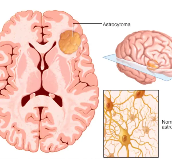 TRATAMENTUL PENTRU GLIOM CEREBRAL