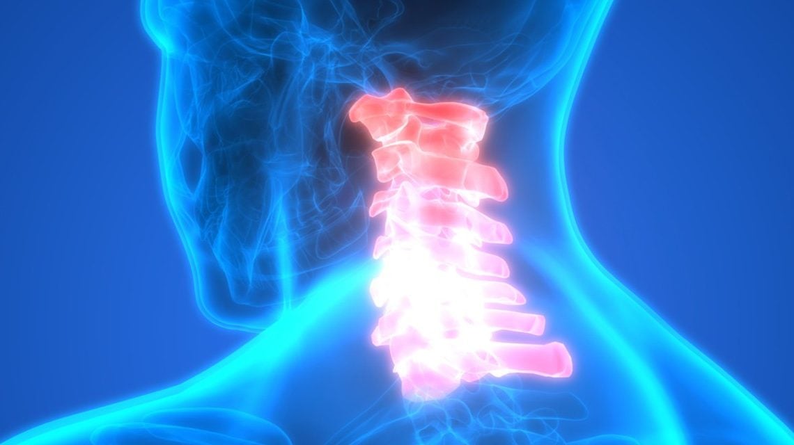 hernia cervicala