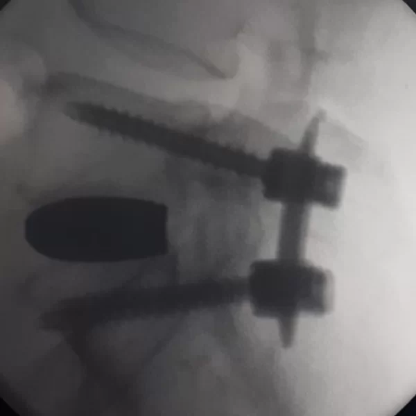 meculescu-dupa-600x600 Cazuri clinice