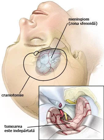 meningiom cerebral