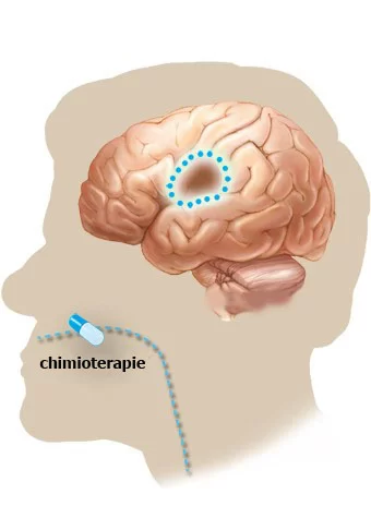meningiom cerebral