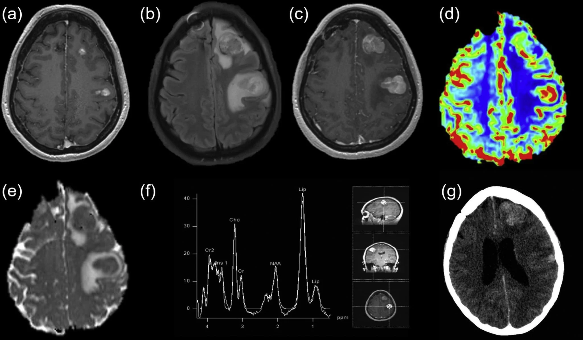 metastaza-cerebrala-4