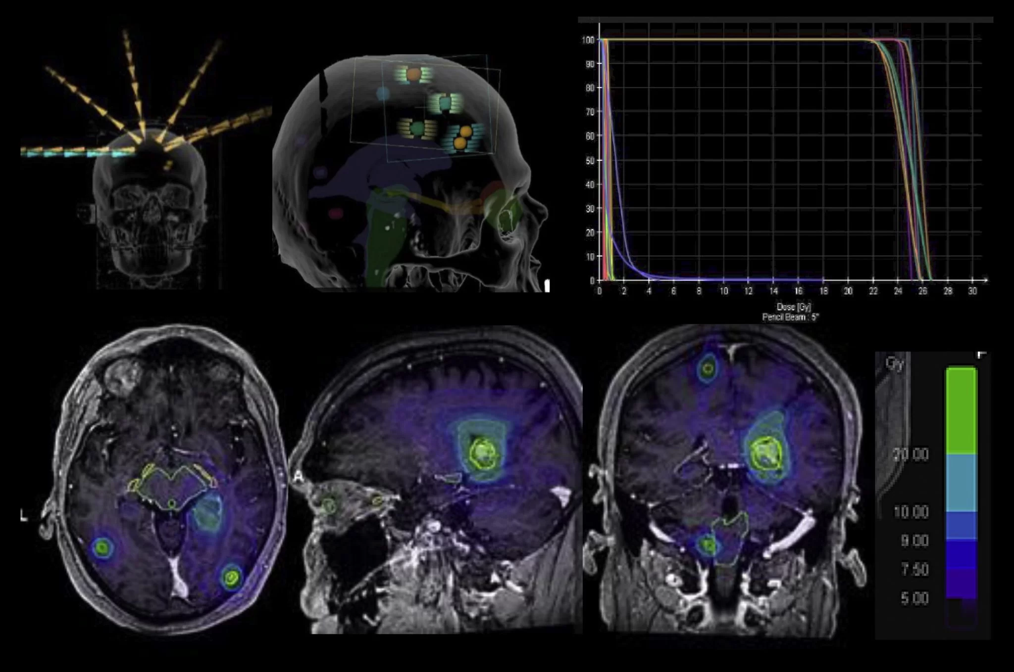 metastaza-cerebrala-5