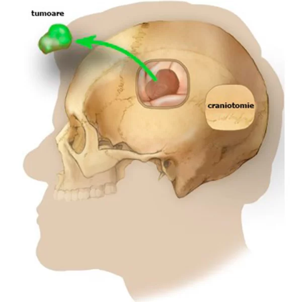 metastaza-cerebrala-7