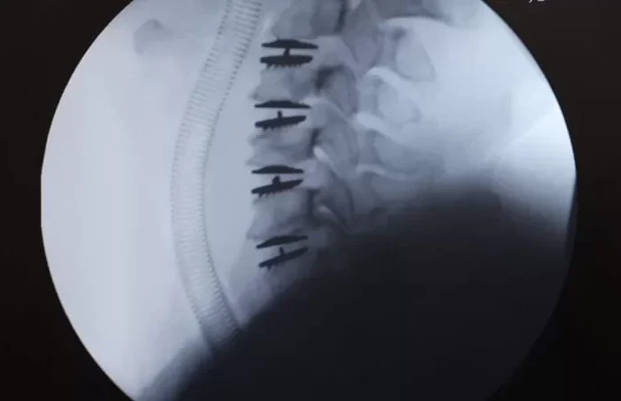 Standardul American în Neurochirurgia Minim Invazivă