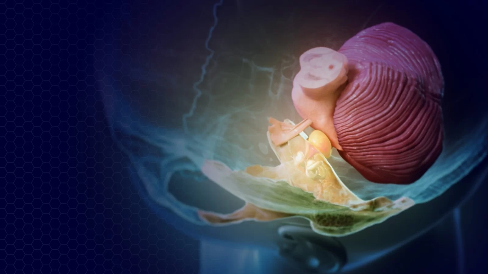 schwanom vestibular