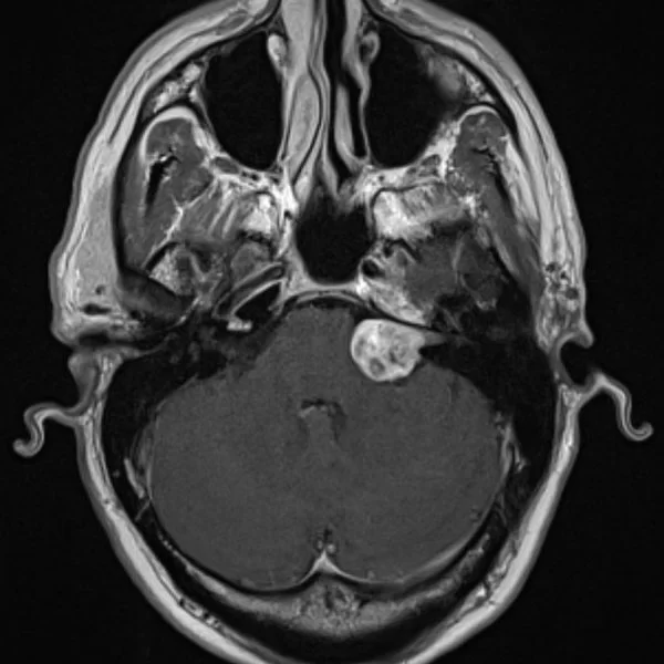 neurinom-acustic-10