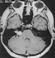 neurinom-acustic-11