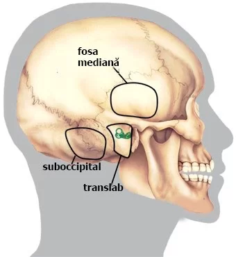 neurinom-acustic-12