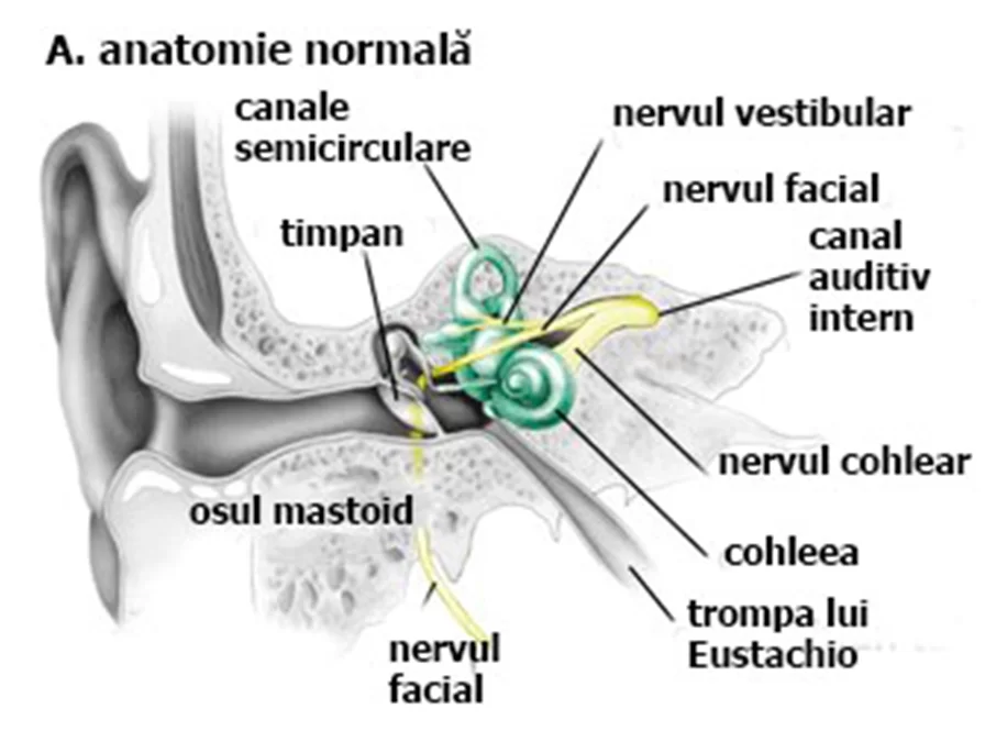 neurinom acustic