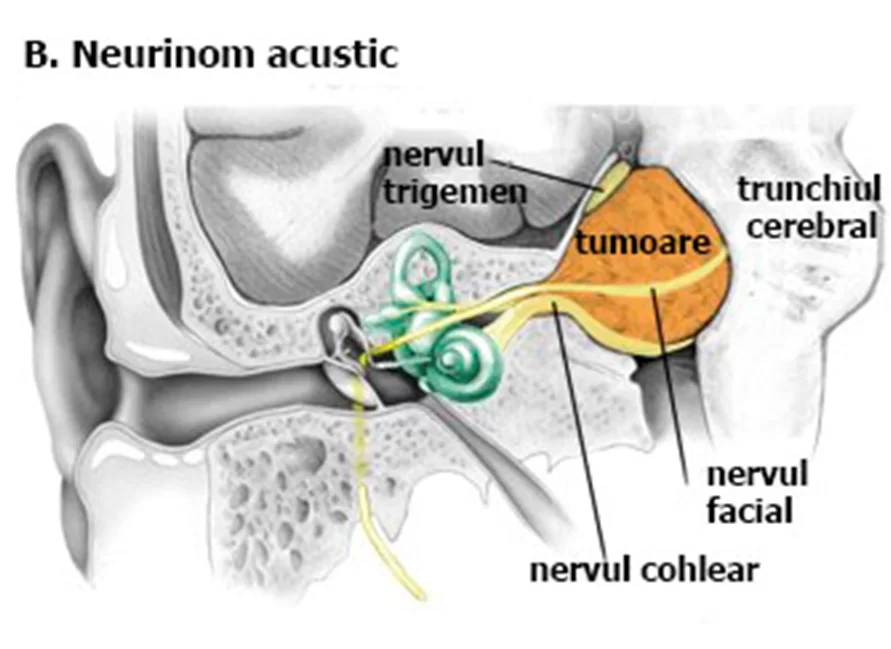 neurinom-acustic-4