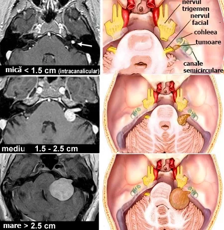 neurinom-acustic