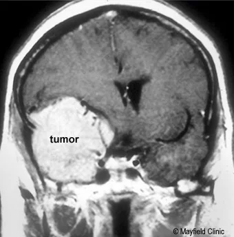 Neurinom acustic - schwanom vestibular