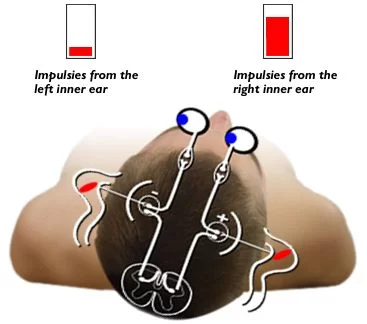 Neurinom acustic - schwanom vestibular