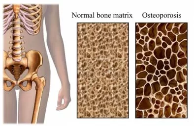 osteoporoza 1