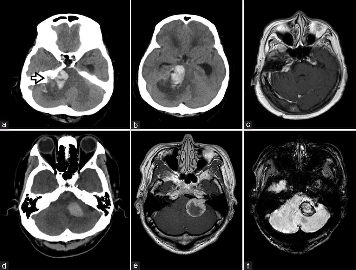 Neurinom acustic - schwanom vestibular