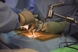 Abordarea neurochirurgicală pentru sindromul „coadă de cal” 