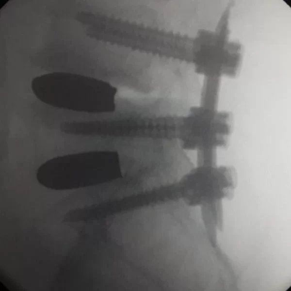 stroe-after-600x600 Cazuri clinice