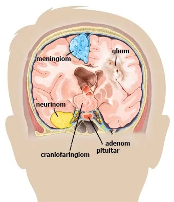Tumoare pe creier - tumora cerebrala