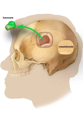 tumoare-pe-creier-6