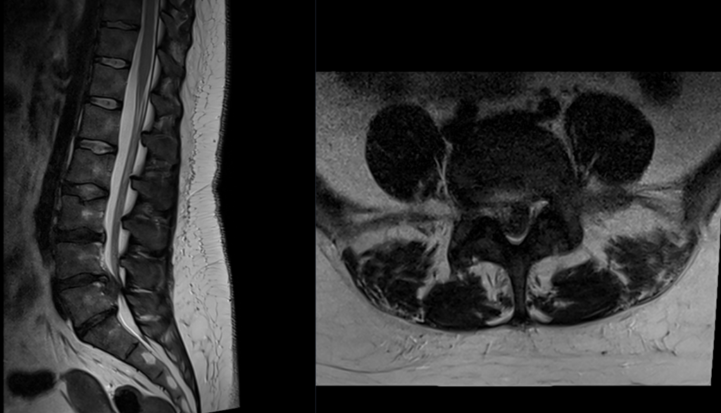 Abordarea neurochirurgicală pentru sindromul „coadă de cal” 
