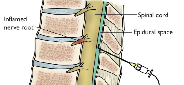 Infiltratii spinale
