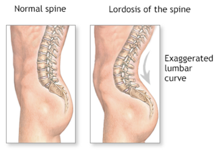 Ce este lordoza