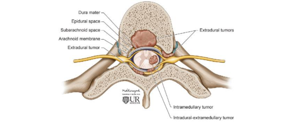 Tumori intradurale extramedulare 