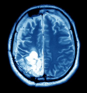 Lupta împotriva cancerului cerebral