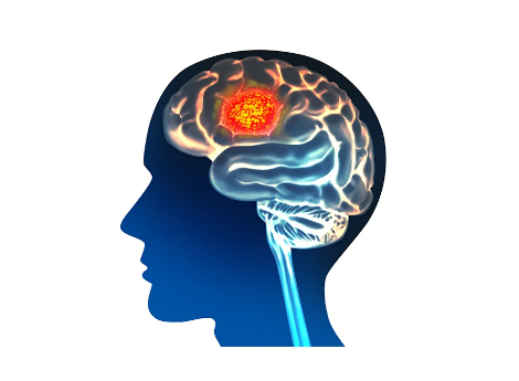 Lupta împotriva cancerului cerebral