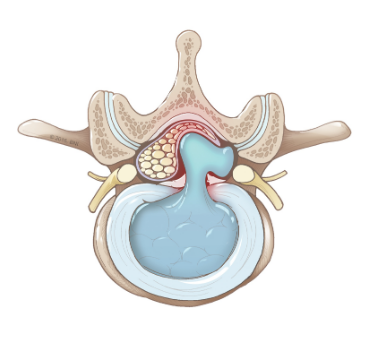 Hernia de disc lombară 