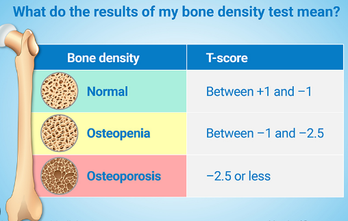 Osteopenia 