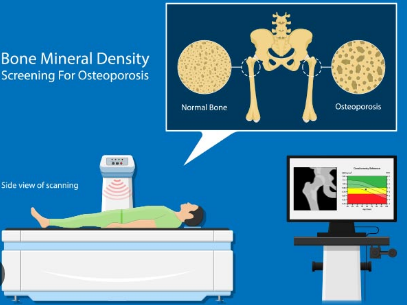 Osteopenia 