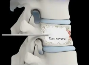 Osteopenia 