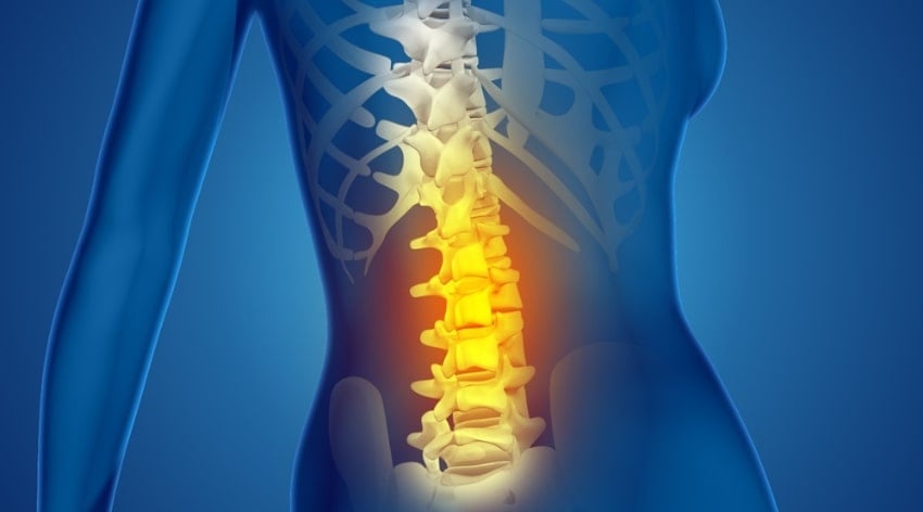Osteofite lombare