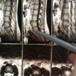 Scolioza-dorso-lombara