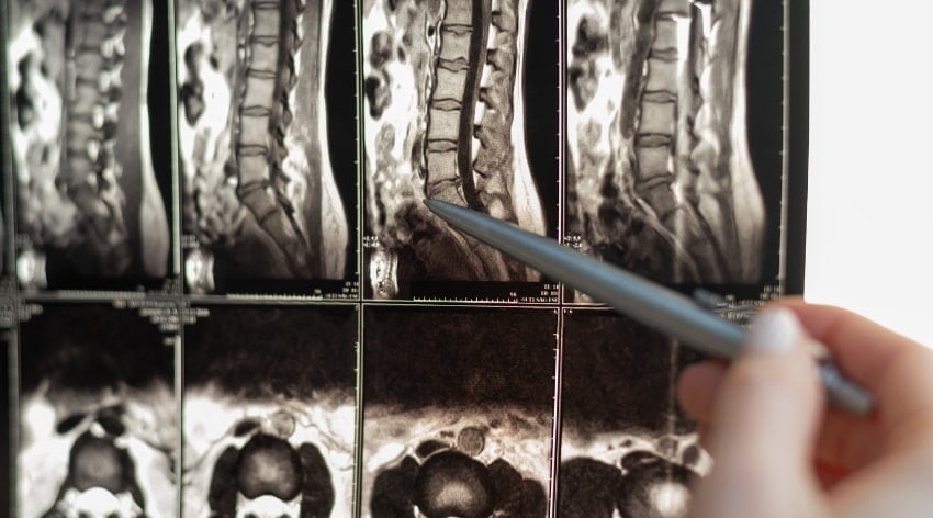 Scolioza-dorso-lombara