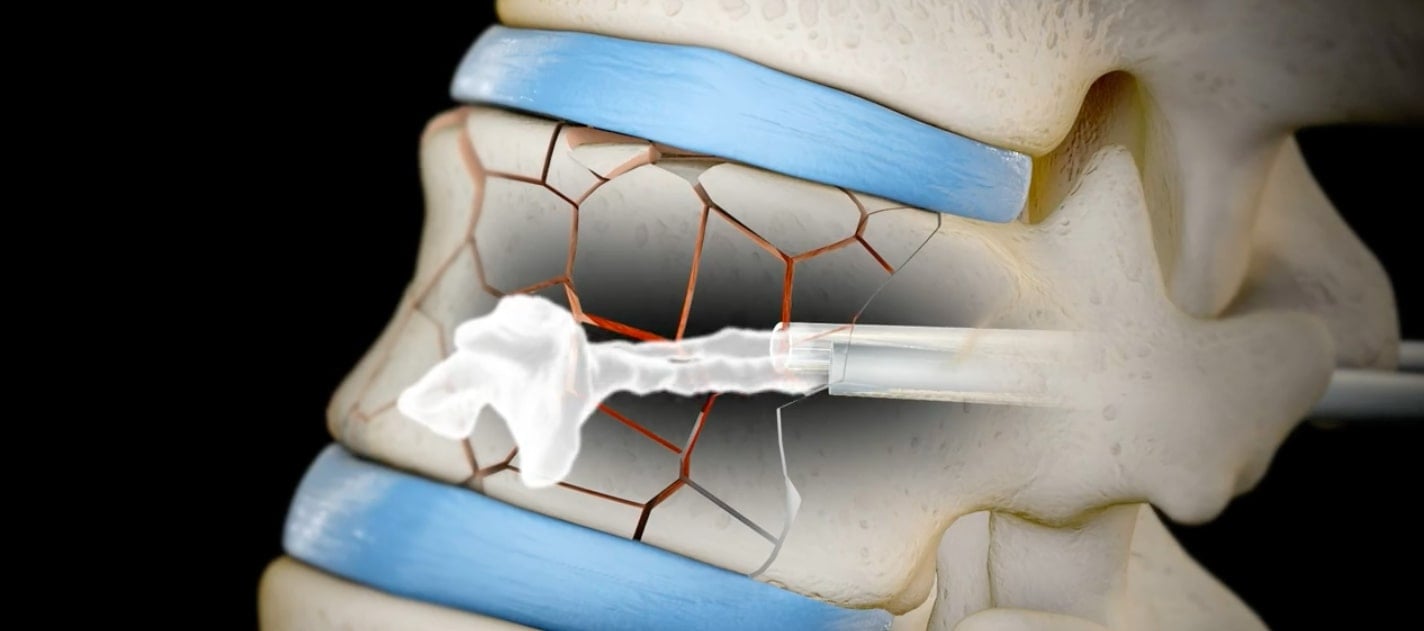 Cifoplastia finalizare